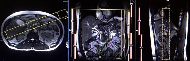 Мрт поджелудочной железы с холангиопанкреатографией thumbnail